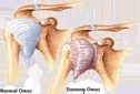 Donuk Omuz Sendromu Belirtileri ve Tedavisi